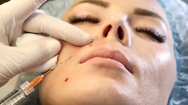 Woman in healthcare clinic. Beauty injection procedure. Close up of cosmetologist holding a syringe with cannula needle penetrating female face. face skin care.4k