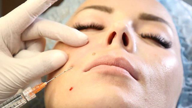 Close up of beautician hands on female client face. doctor holds a syringe with cannula needle. Face lifting concept. 4k