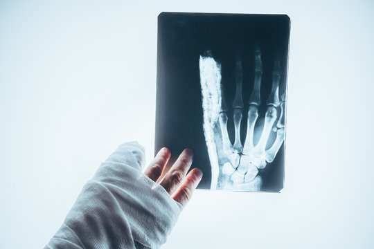 Diagnosis of damage using X-ray of the hand on the lumen