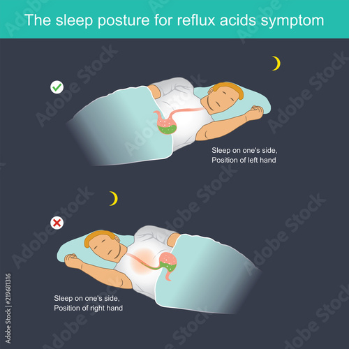 "The sleep posture for reflux acids symptom" Stock image and royalty