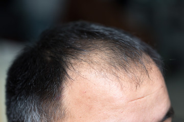 Obraz premium A middle-aged man with hair loss. Baldness