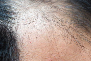 A middle-aged man with hair loss. Baldness