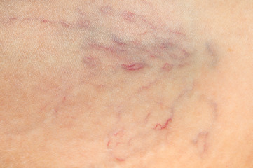 Fototapeta premium Close-up view of spider veins on female leg