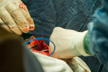 Close-up of a surgeon's arm with a bandage and a clamp to stop bleeding during trepanation of the skull.