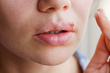 Fototapeta premium Part of a young woman's face with a virus herpes on lips, treatment with ointment