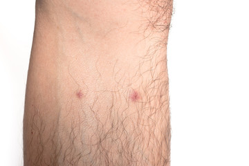 Fototapeta premium red dot on skin from bite bugs