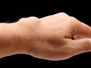 carpal ganglion cyst in wrist on black blackground

