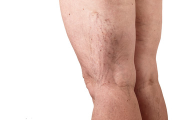 the disease varicose veins on a womans legs. white background