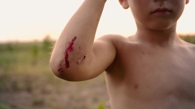 A small fresh scratch on the child's hand, a trauma on the boy's elbow after the fall, blood on the child's hand