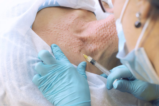 The cosmetologist injects the patient into the neck. first person view. closeup