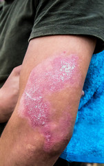 Scar from the burn on the arm