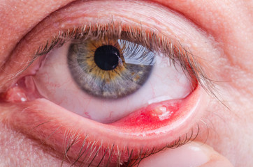 Stye (hordeolum) disease on eye of a caucasian female