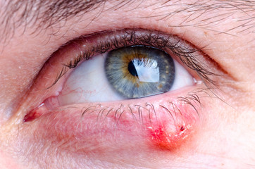 Stye (hordeolum) disease on eye of a caucasian female