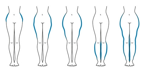Schaubild Lipödem Blau