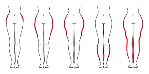 Schaubild Lipödem Pink