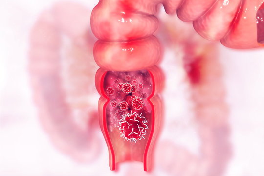 Colon cancer. Cancer attacking cell. Colon disease concept