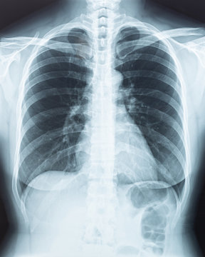 Chest X-ray of human physical body radiography with digital imaging film displaying internal organ of woman patient's health (lung, heart, spine skeleton) illness for medical diagnostic analysis