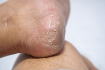 Close up Dermatitis of Heel break, Skin peeling in men on foot.