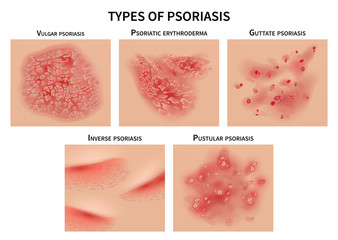 Psoriasis types. Skin hives, derma diseases. Closeup medical vector illustration