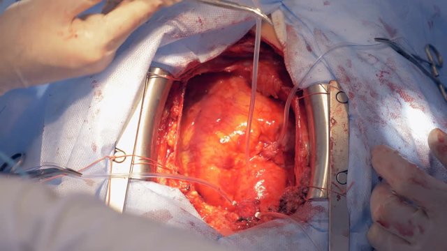 Heart surgery at a hospital, close up. Doctors perform an open heart surgery at a clinic.