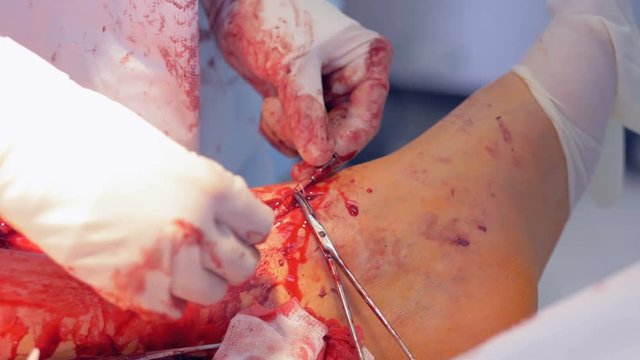 Two surgeons performing a heart operation, stitching an incision. 4K.
