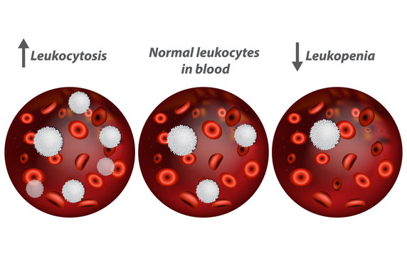 Leukocytosis and Leukopenia. White blood cell count. 