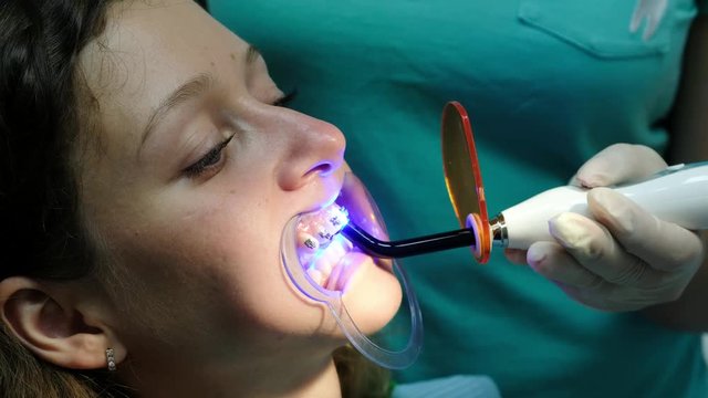 Visit to the dentist. Stomatologist shines with a dental polymerization UV lamp on the braces to the patient close-up.