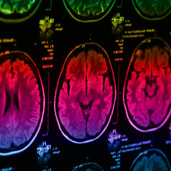 Obraz na płótnie Canvas The X-ray of the human brain
