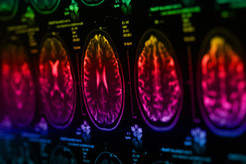 The X-ray of the human brain
