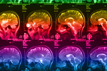 The X-ray of the human brain