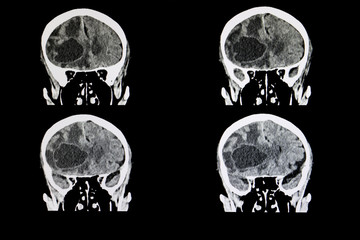 metastatic brain tumor