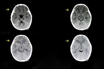 a child with subdural hematoma