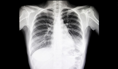 Pneumonia Chest Film
