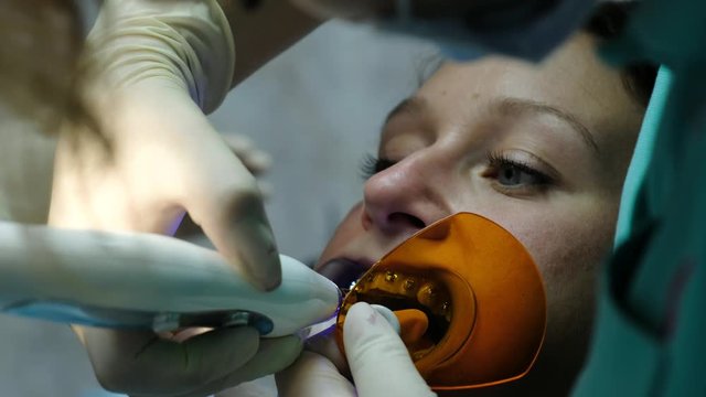 Visit to the dentist, installation of the bracket system, correction of the malocclusion. Assistant shines with a dental polymerization ultraviolet lamp to fixation the brackets close-up.