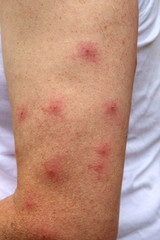 Naklejka premium A mature man dressed in a t shirt displays a strong reaction to the mosquito bites on his bare arm