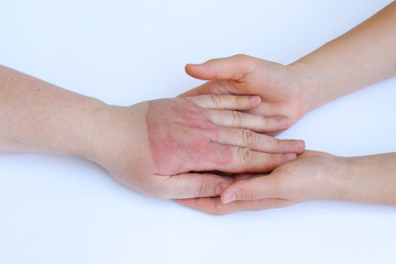 Doctor's hands holding female hand with second degree burns on white background. Doctor examining of the patient. Patient cheering and support