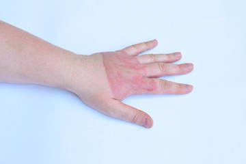 Horrible second degree burns on female hand on white background