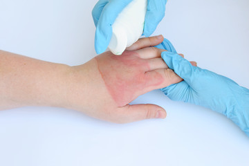Doctor's hands holding female hand with second degree burns on white background. Treatment of burns...
