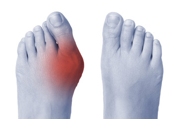 Female foot with bunion on big toe