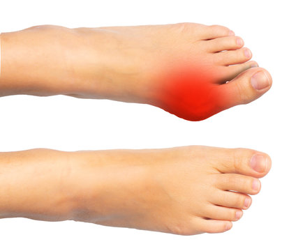 Feet before and after bunion surgical removal