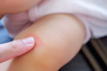mother apply antiallergic cream at baby knee with skin rash and allergy with red spot cause by mosquito bite