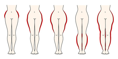 Schaubild Lipödem Rot