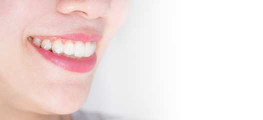 Close up view of a woman putting on invisalign braces