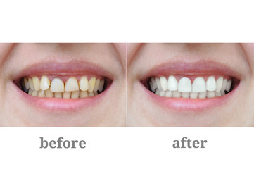 Teeth close-up after dental therapy and whitening. Before and after.