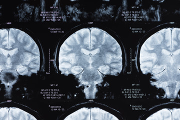 brain mri