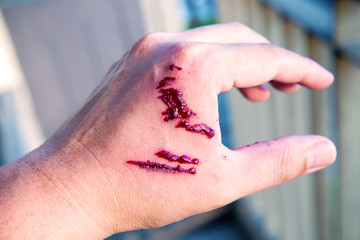 Focus dog bite wound and blood on hand. Infection and Rabies concept. Pet care and rabies prevention concept. Accidental and first aid concept. image for background, objects, copy space.