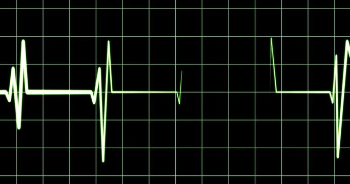ECG, electrocardiogram showing a faltering heart rate, diagnosis cardiac arrest, medical technology in emergency room, falling pulse, death, artwork in medicine, green wave on black, 4k loop