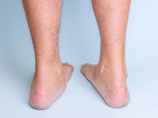 Legs of a man with a pronounced flat feet. Rear view.