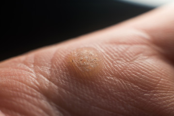Verruca on hand, wart freeze concept, selective focus