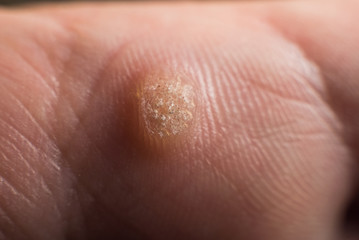 Verruca on hand, wart freeze concept, selective focus